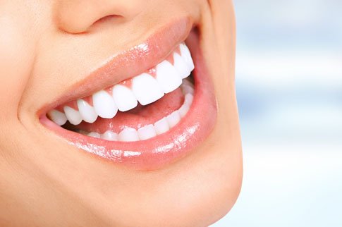 Faccette estetiche